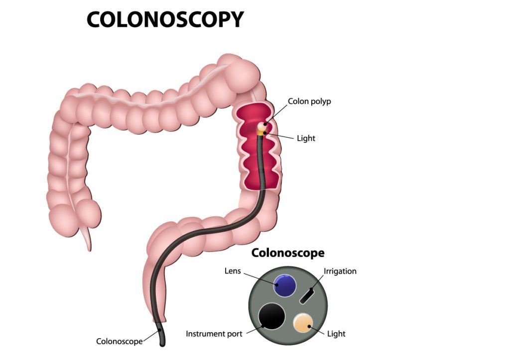 Colonoscopy procedure