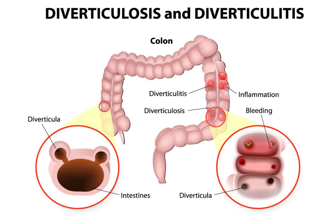 Colonoscopy procedure