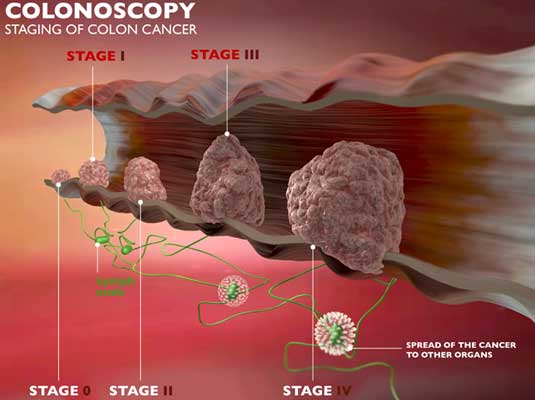 Endoscopy For Colon Cancer