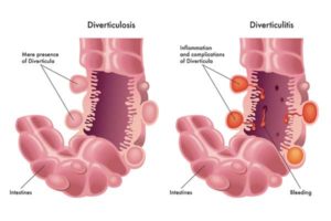Diverticulosis, diverticulitis symptoms, inflammatory bowel disease, what is diverticulitis, diverticulitis treatment, diverticulitis causes