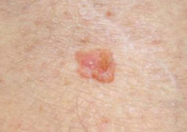 types of skin cancer, skin cancer treatment, skin cancer types, signs of skin cancer, skin cancer detection, skin cancer look like, skin cancer moles pics