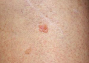 types of skin cancer, skin cancer treatment, skin cancer types, signs of skin cancer, skin cancer detection, skin cancer look like, skin cancer moles pics
