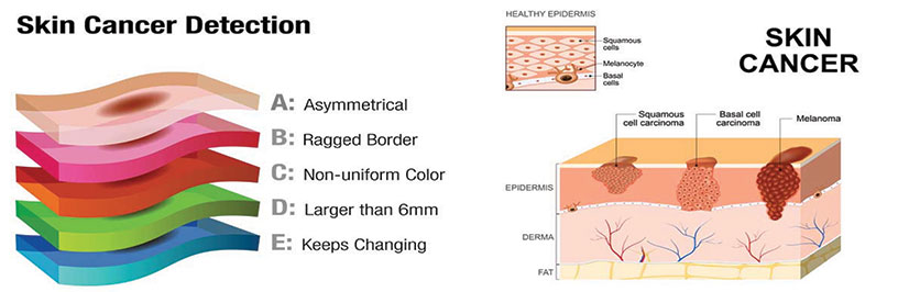 skin cancer detection, skin cancer look like, how skin cancer look like, signs of skin cancer