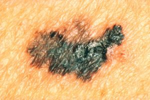melanoma skin cancer, melanoma cancer, malignant melanoma, which skin cancer is the most dangerous, which skin cancer has the worst prognosis, which skin cancer is the biggest killer, which skin cancer is the deadliest