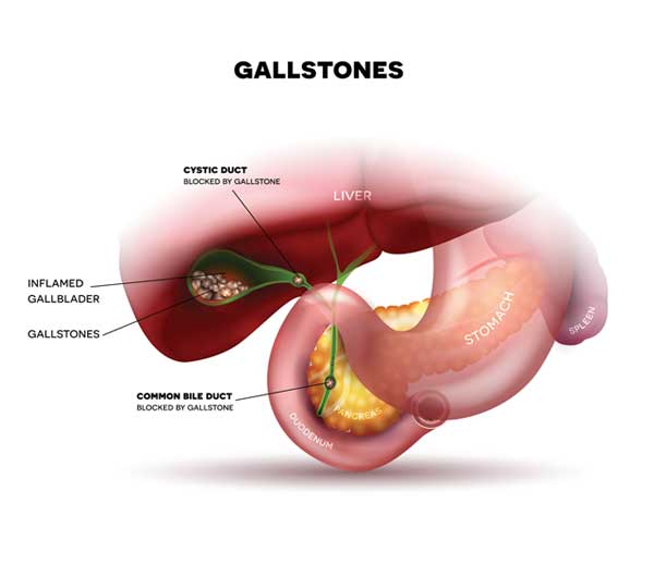 Gallbladder, Gallstones, gallbladder pain, gallbladder symptoms, gallbladder surgery, gallbladder removal, gallstones symptoms, what causes gallstones, gallbladder disease, gallbladder stones
