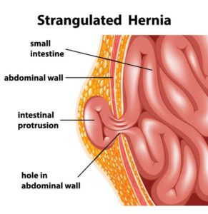 hernia surgery doctor near me, hernia surgery and recovery, hernia surgery procedure, hernia surgery, hernia repairs